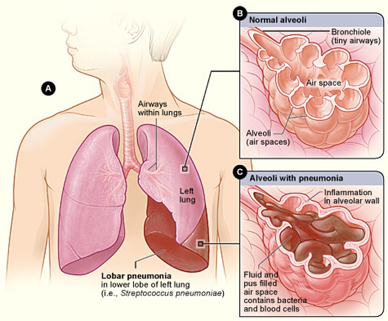 Pulmicort Respules combined with Ventolin nebulization treatment